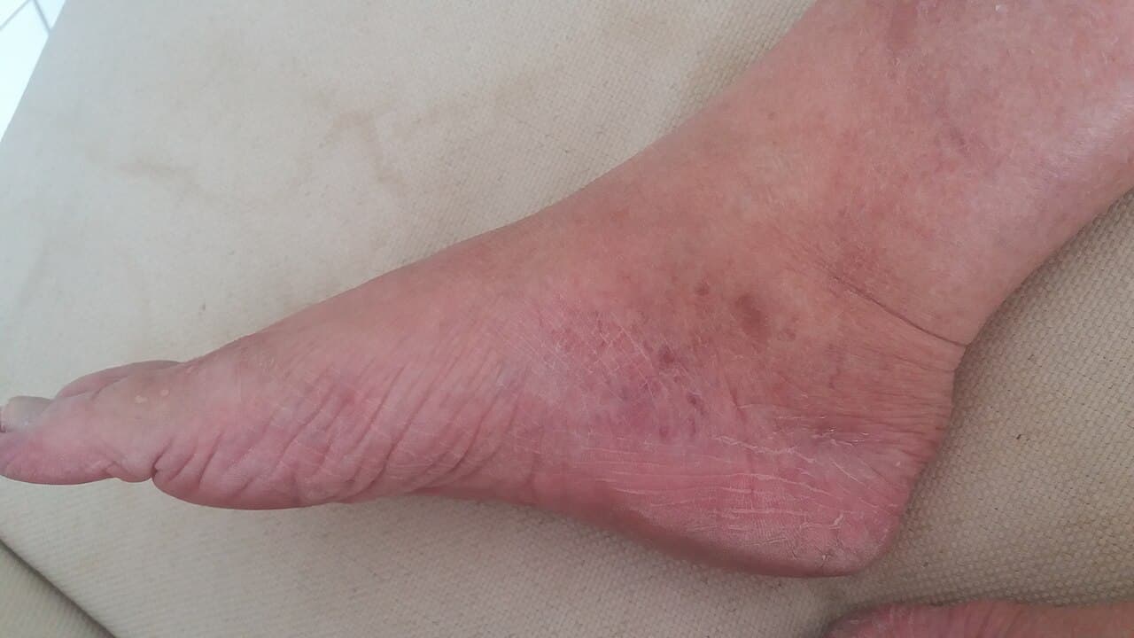 Nişantaşı'da Topuk Dikeni ve Plantar Fasiit Nasıl Yönetilir? Ne Yapılır?